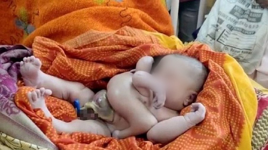 Bebê nasce com 4 braços e 4 pernas; é tratado como Deus na Índia; veja