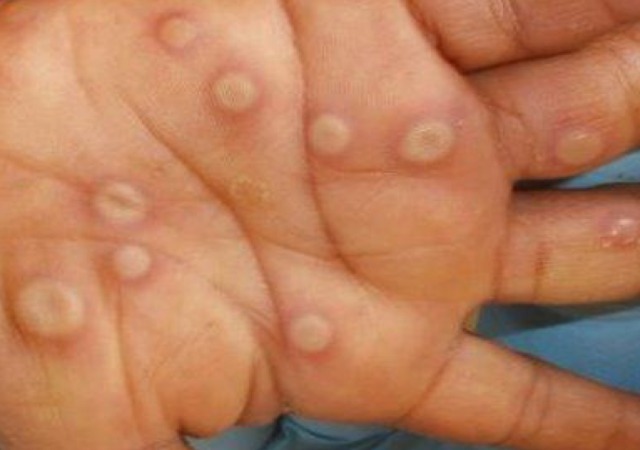 Pará confirma novo caso de varíola dos macacos