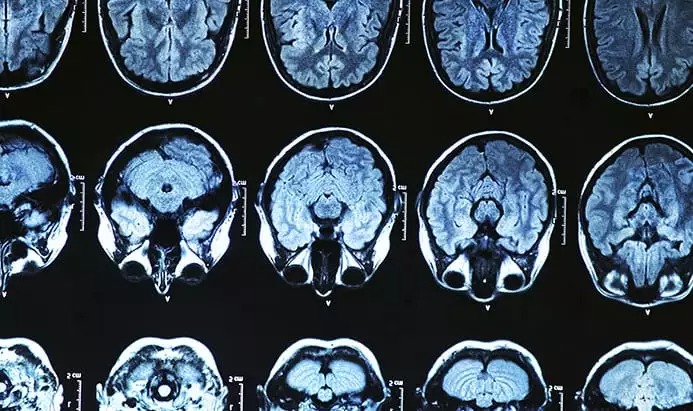 Medicação conhecida como "lecanemab" pode ajudar contra Alzheimer