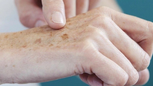 Uma lesão, ferida ounódulo na pele que apresenta a evolução lenta. Atenção, você pode estar diante de um caso de câncer de pele.