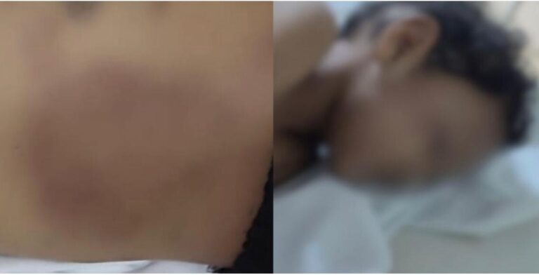 🚨Imagens Fortes mostram como um menino de 4 anos deu entrada na UPA após ser espancado e abusado pela mãe e madrasta Na tarde