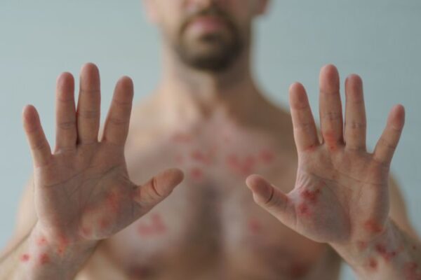 🧬🦠Saúde: A mpox vai ser a próxima Covid? Tire dúvidas A mpox recebeu o mais alto nível de alerta da Organização Mundial da Saúde (OMS)