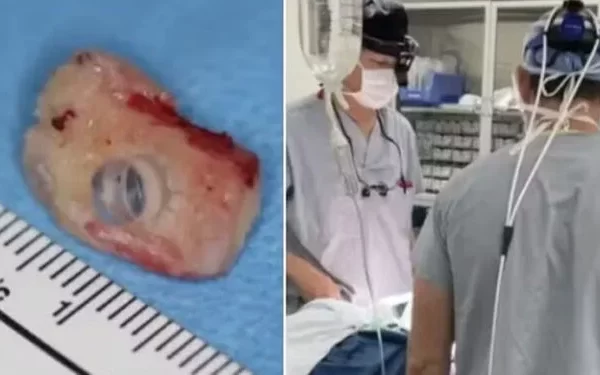 Um procedimento cirúrgico inovador está devolvendo a esperança de visão a Brent Chapman, um canadense de 33 anos que perdeu...