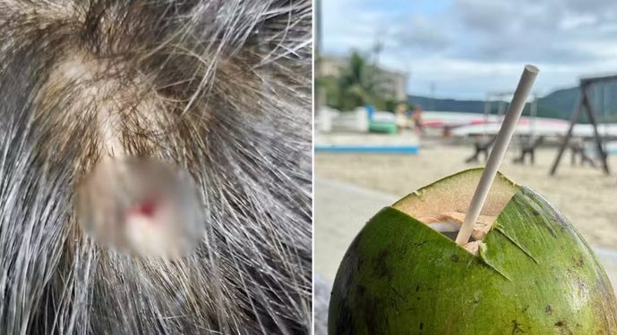 Uma mulher de 55 anos foi ferida na cabeça por um fragmento de facão que se soltou durante o corte de cocos em um quiosque na orla de...
