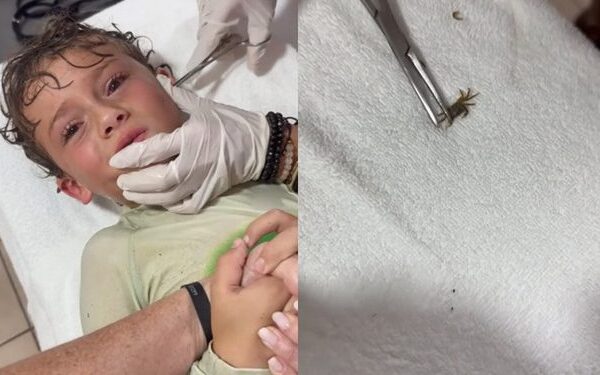 Após um dia de praia, menino tem caranguejo vivo retirado do ouvido