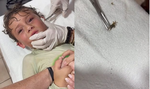 Após um dia de praia, menino tem caranguejo vivo retirado do ouvido